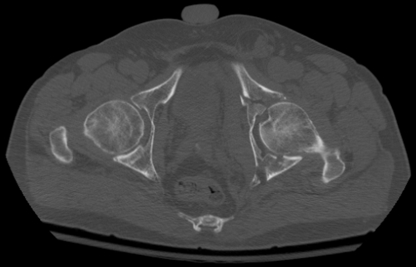 CT reconstruction showing an acetabular fracture