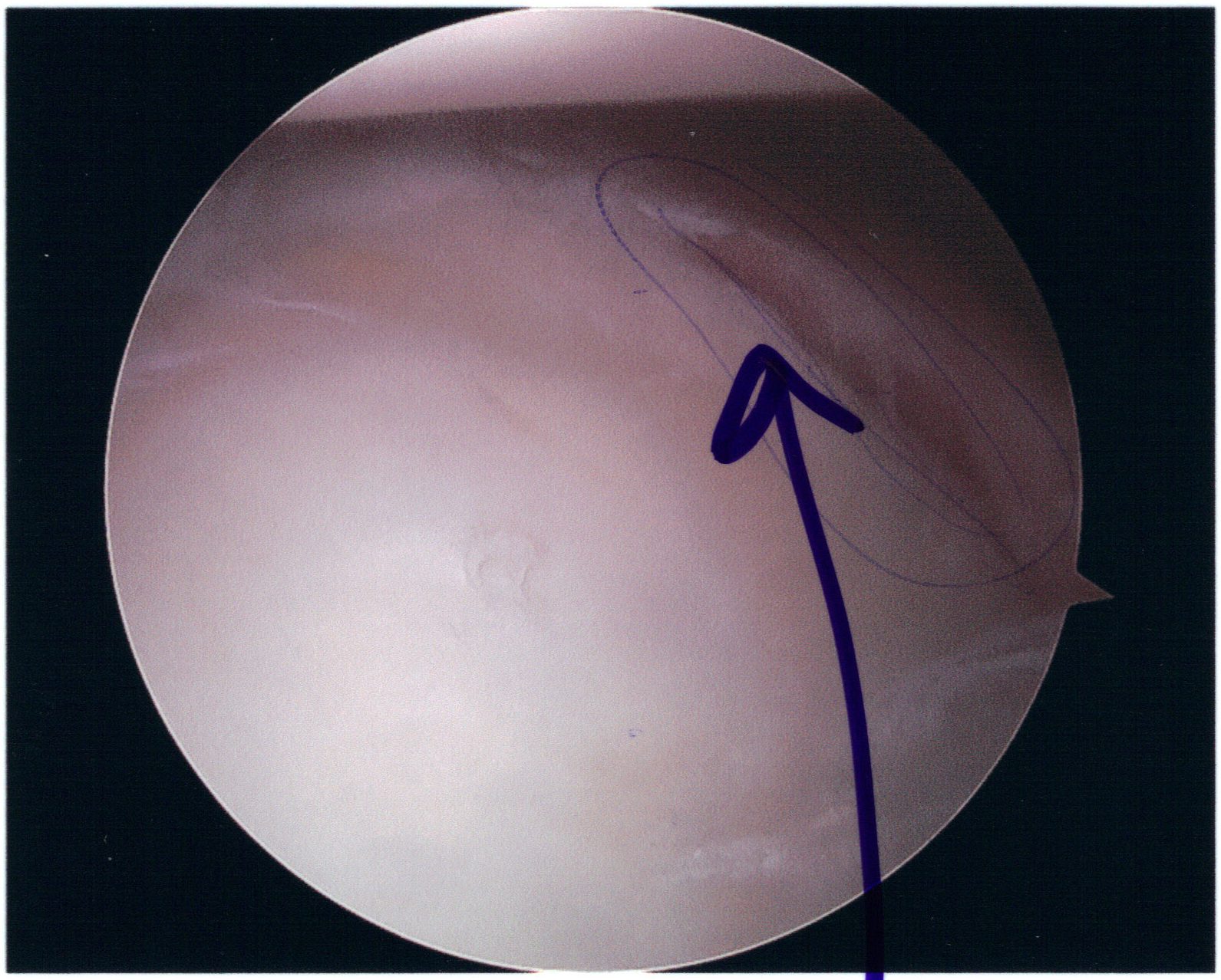 Arthroscopic view of a Bankart lesion of the anteroinferior glenoid labrum