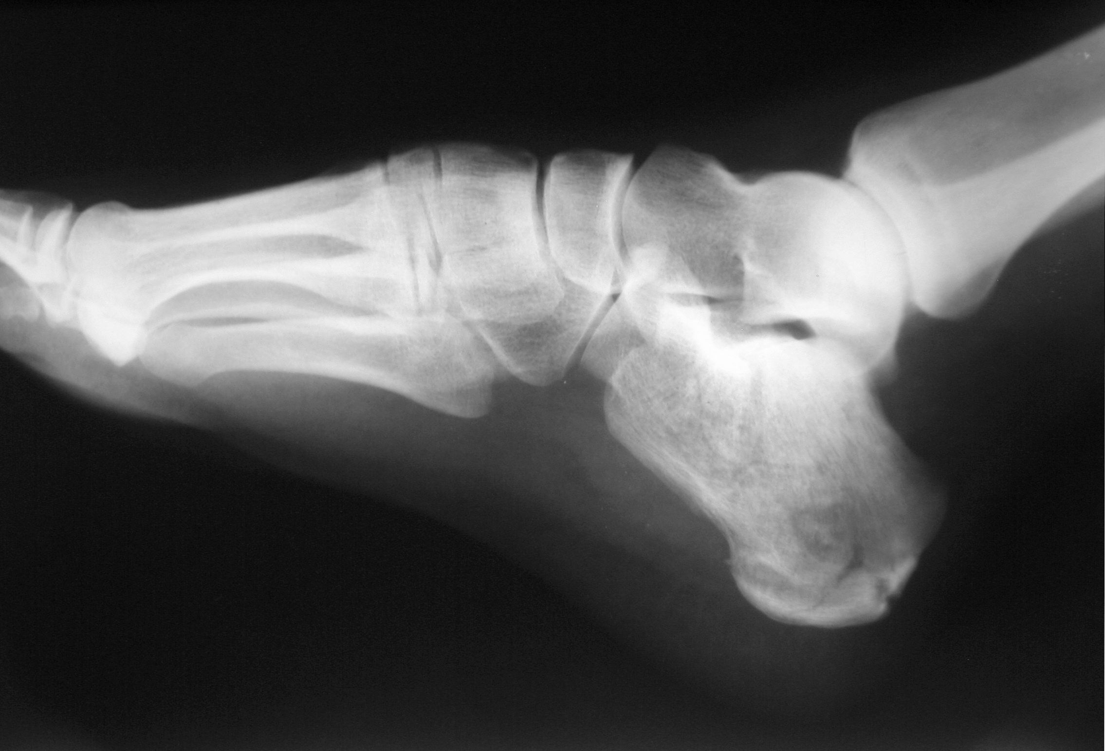 Lateral foot X-ray showing a comminuted calcaneus (heel-bone) fracture