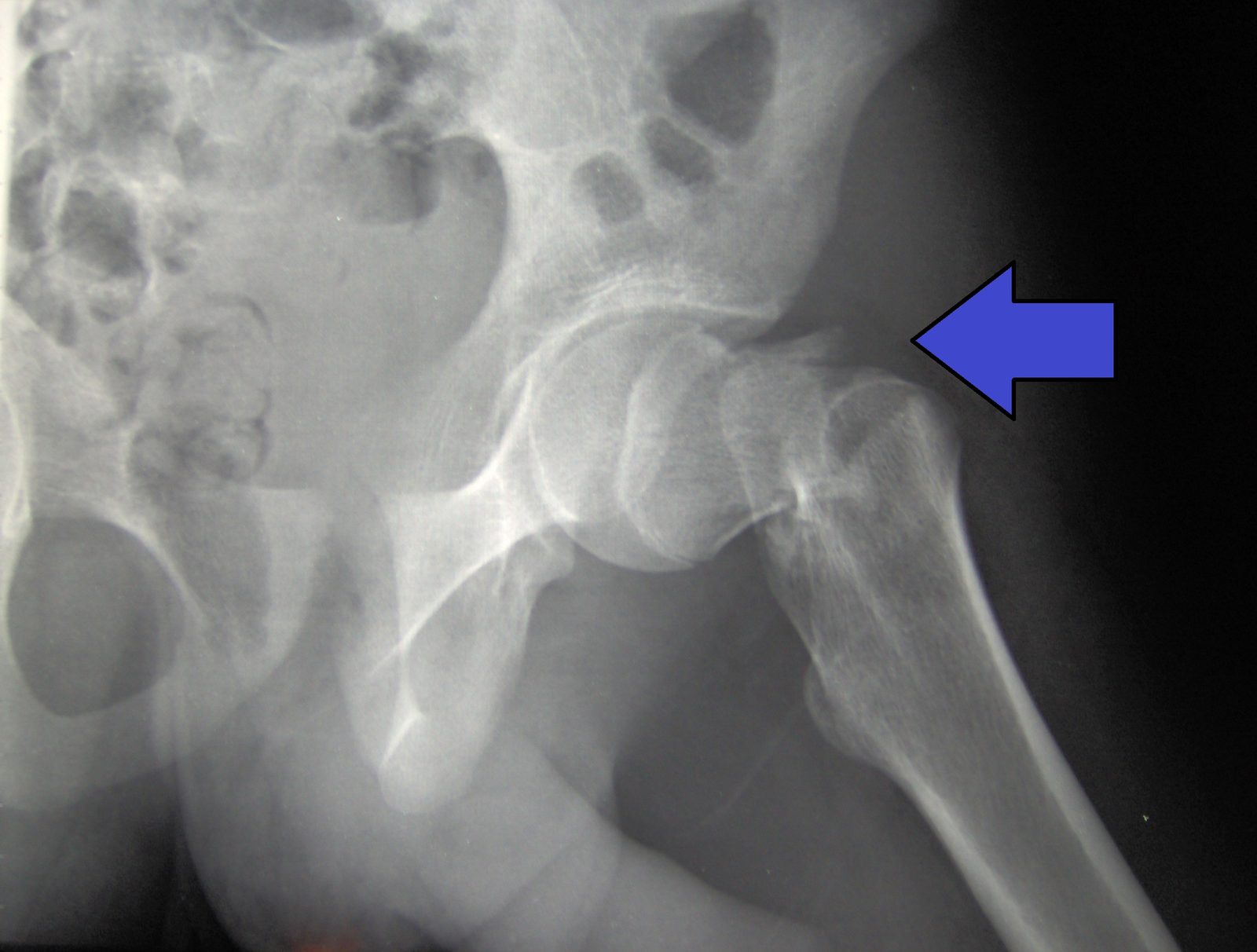 Pelvis X-ray showing a proximal-femur (intertrochanteric-type) fracture