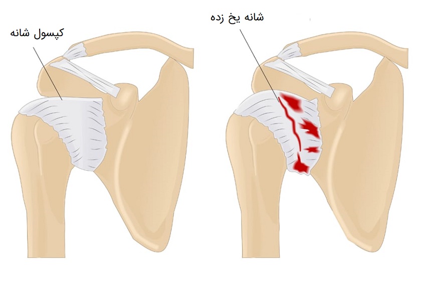 Illustration showing the thickened, contracted capsule of a frozen shoulder
