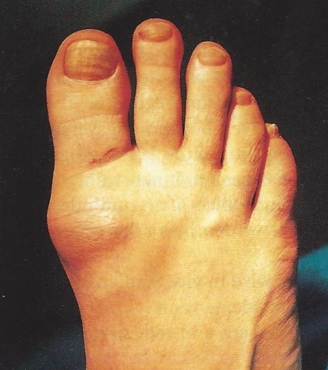Clinical photograph of a great-toe MTP joint with hallux rigidus