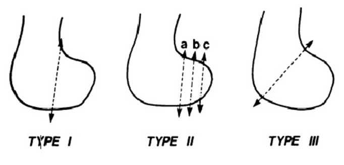 Classification diagram of distal-femur (Hoffa-type) lateral-condyle fractures