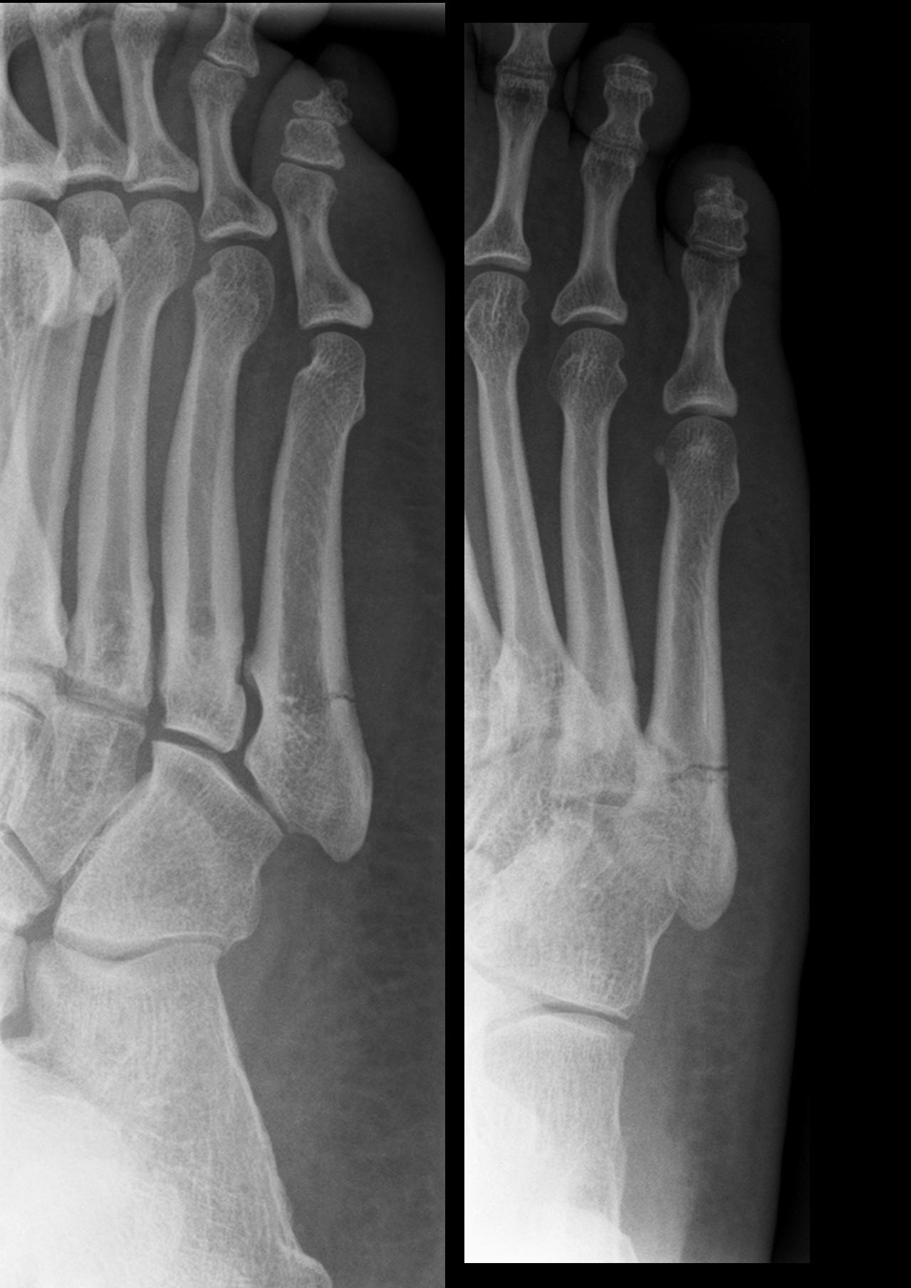 Oblique foot radiograph of a fifth-metatarsal (Jones) fracture