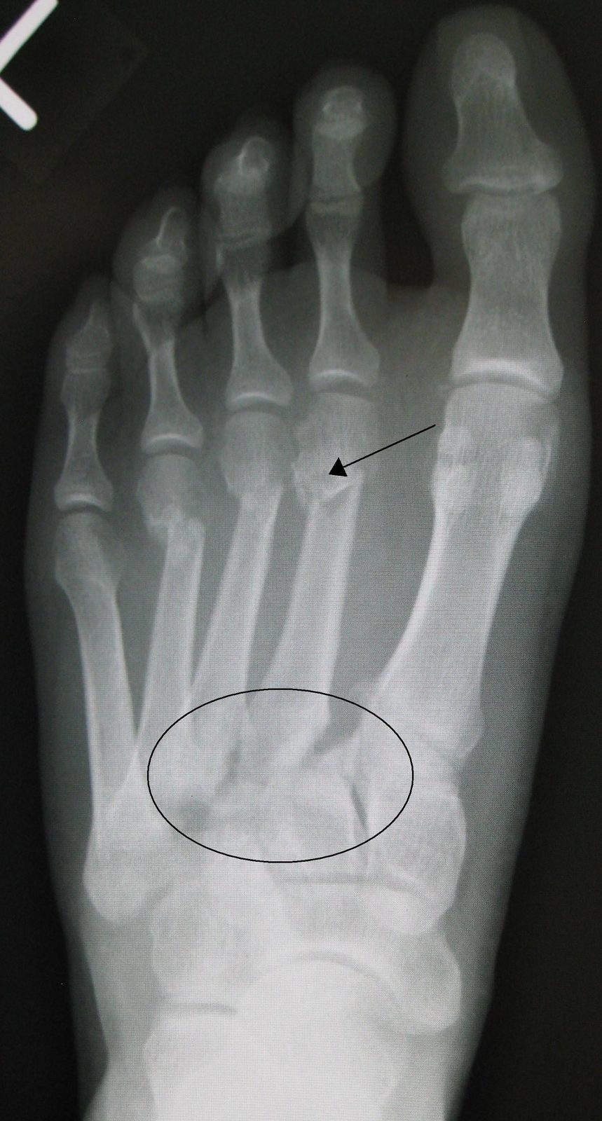 Anteroposterior foot X-ray of a Lisfranc tarsometatarsal fracture–dislocation