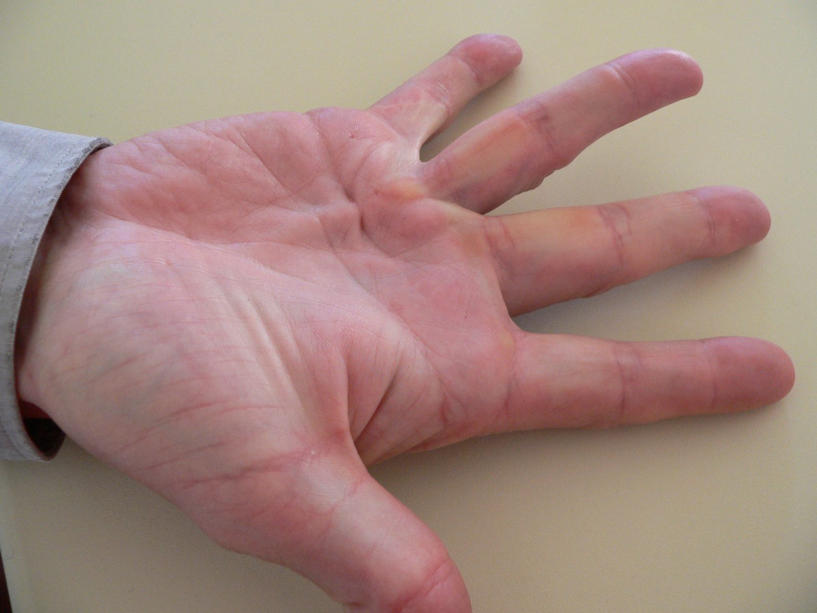 Photograph of a hand with Dupuytren's contracture showing cord formation in the palm and fixed flexion of the ring finger
