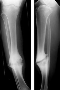 Radiograph showing a fracture nonunion with persistent lucency between fragments