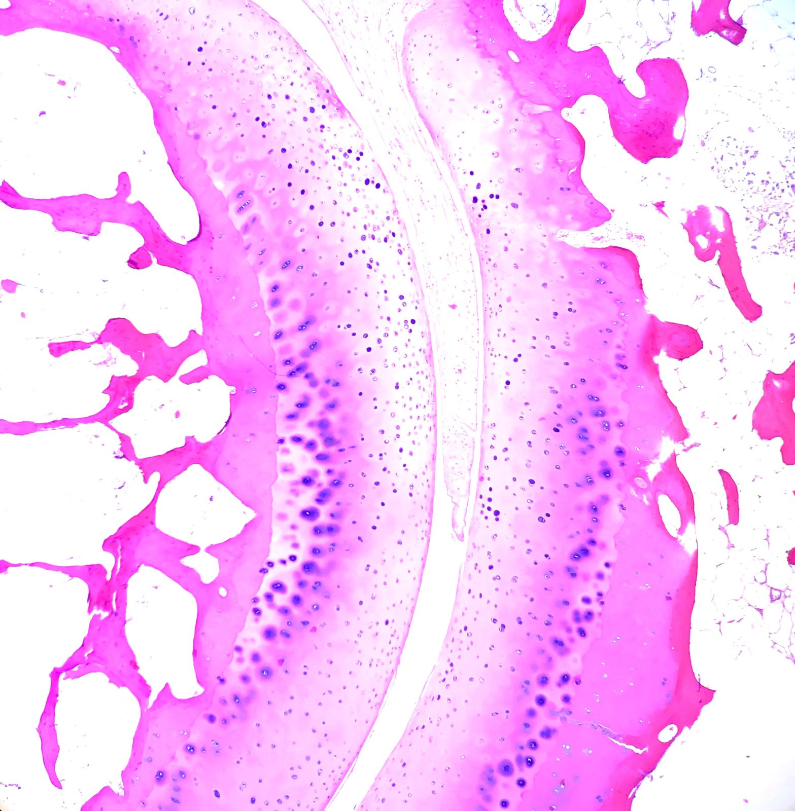 Diagram of a normal metatarsophalangeal joint, relevant to forefoot pain