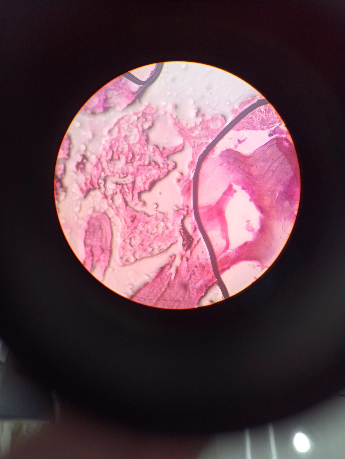 Radiograph of a long bone with findings of osteomyelitis