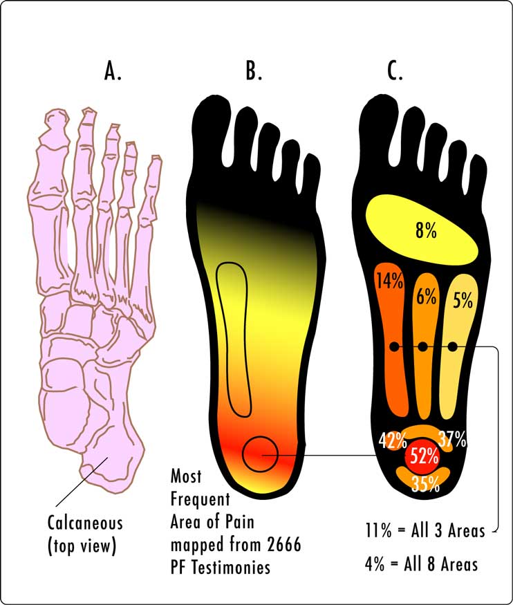 Diagram of the plantar fascia running from the heel bone to the toes, showing typical areas of pain in plantar fasciitis
