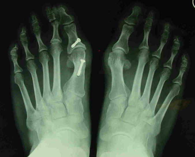 Photograph of a foot with hallux valgus showing bunion deformity at the big toe