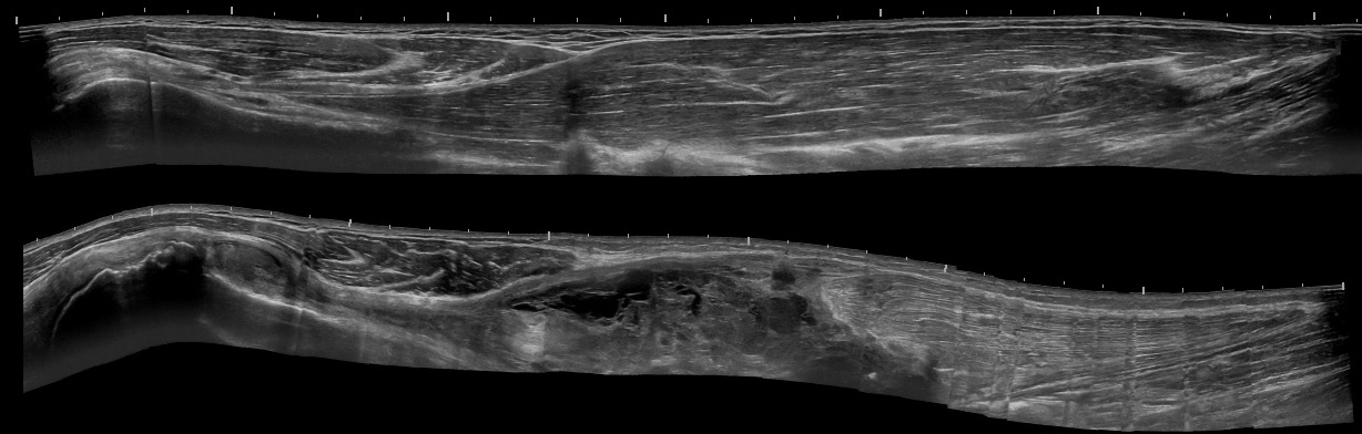 Panoramic ultrasound showing a ruptured long head of biceps tendon