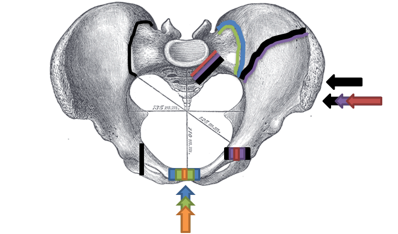 Diagram of the Young–Burgess classification of pelvic-ring fractures