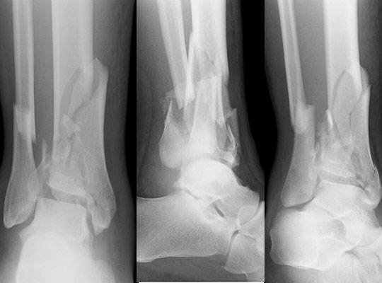 Ankle X-ray showing a distal-tibial pilon fracture