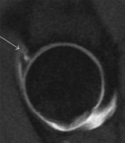 Sagittal T1 hip MRI showing a labral tear at the acetabular rim