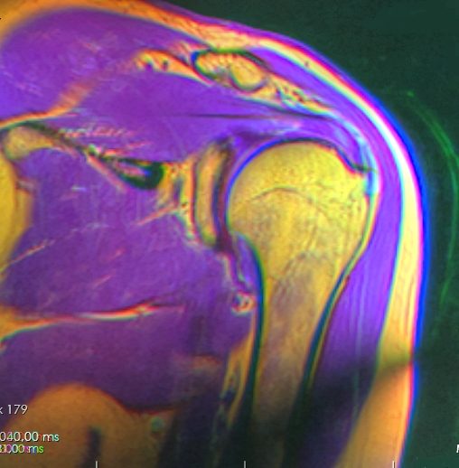 Coronal shoulder MRI demonstrating rotator cuff tendon pathology