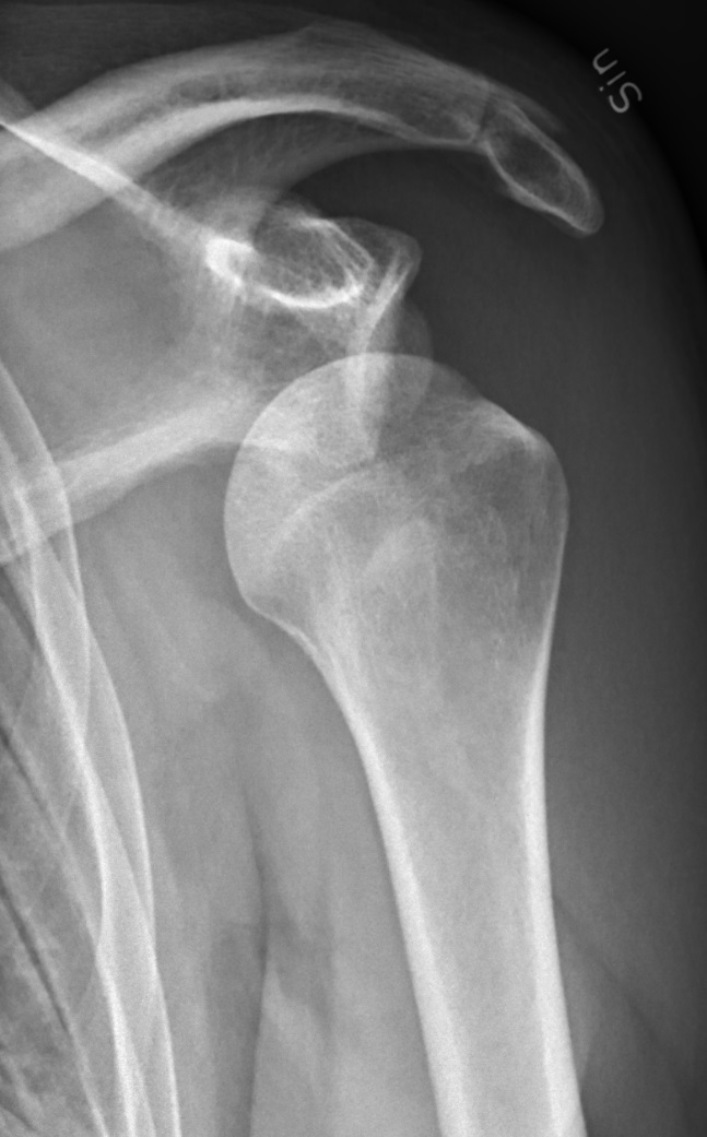 AP shoulder X-ray showing an anterior glenohumeral dislocation before reduction
