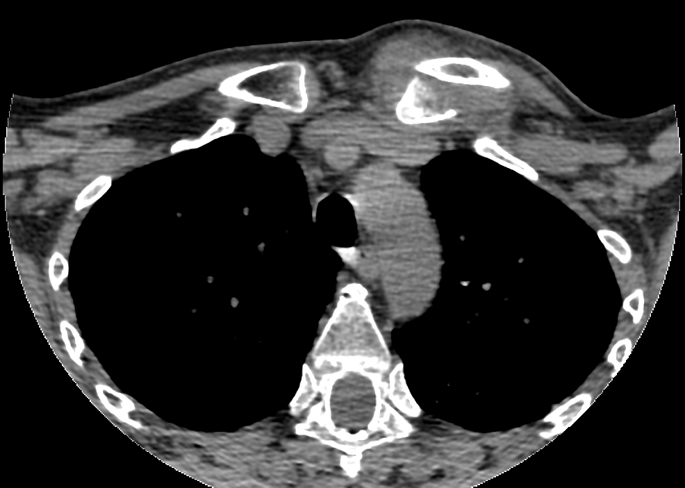 CT reconstruction of a left sternoclavicular fracture–dislocation