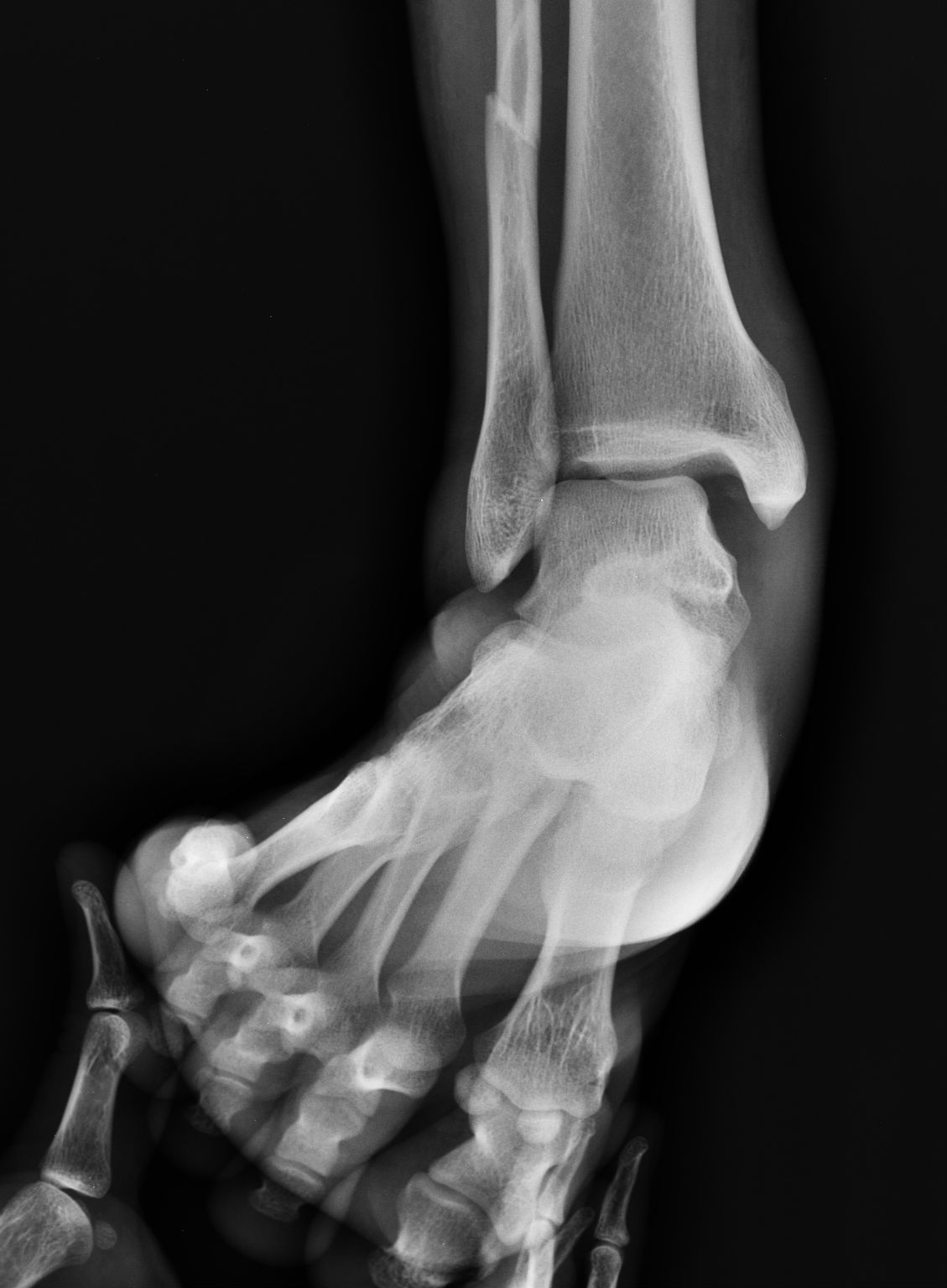 Stress-view ankle X-ray showing medial-clear-space widening from a high-ankle-sprain-type injury