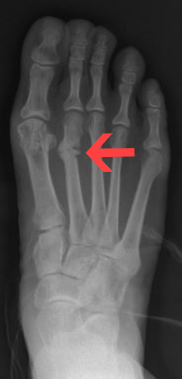 Radiograph showing a stress fracture of the second metatarsal with surrounding callus
