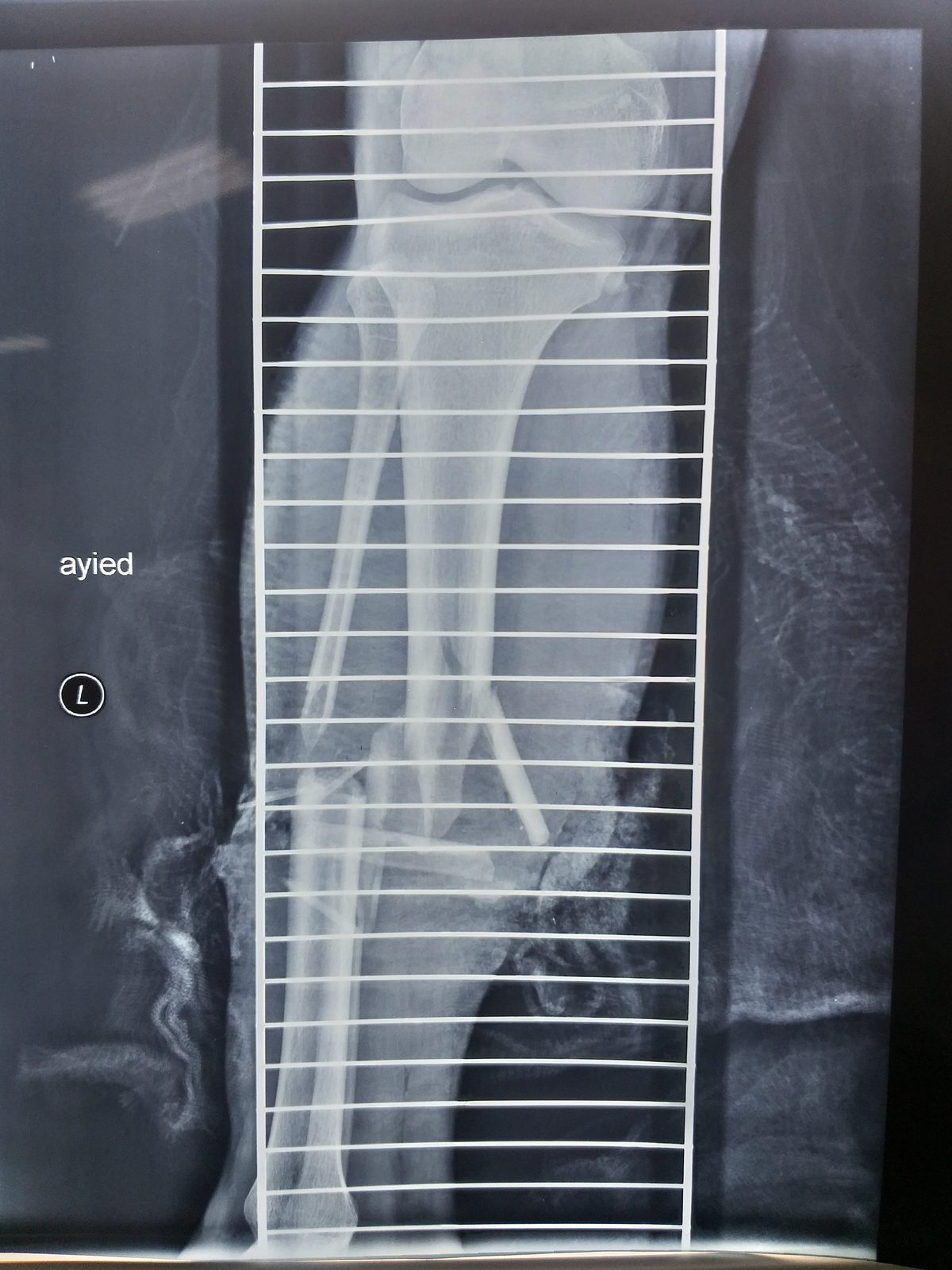 Photograph of an open tibial–fibular shaft fracture with overlying wound