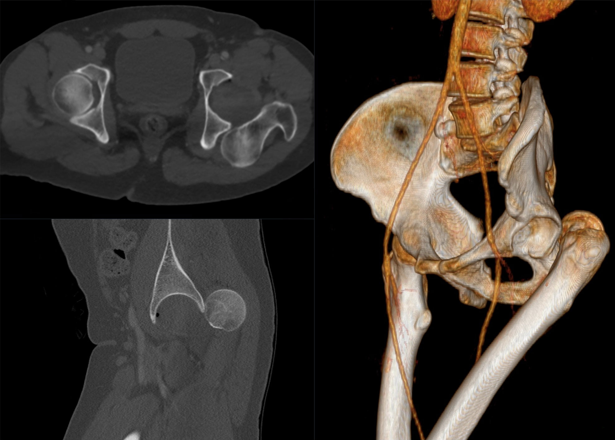 CT image showing a traumatic posterior dislocation of the left hip