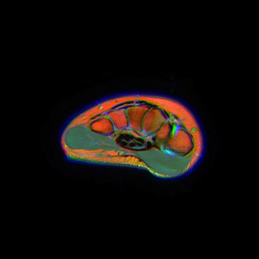 Wrist MRI slice demonstrating the anatomy addressed during carpal tunnel release