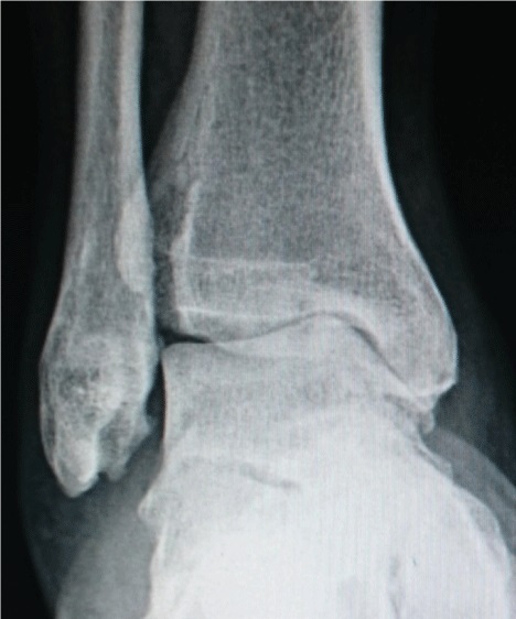 Lateral X-ray of an ankle showing osteoarthritic joint-space narrowing and osteophytes