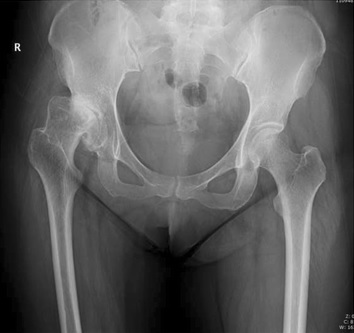 Pelvis X-ray showing developmental dysplasia of the hip in an adult
