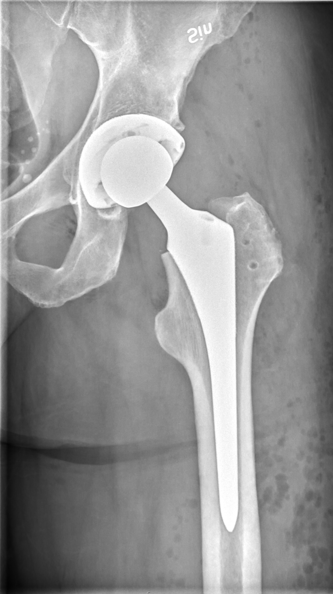 AP radiograph showing a total hip arthroplasty with femoral stem and acetabular cup