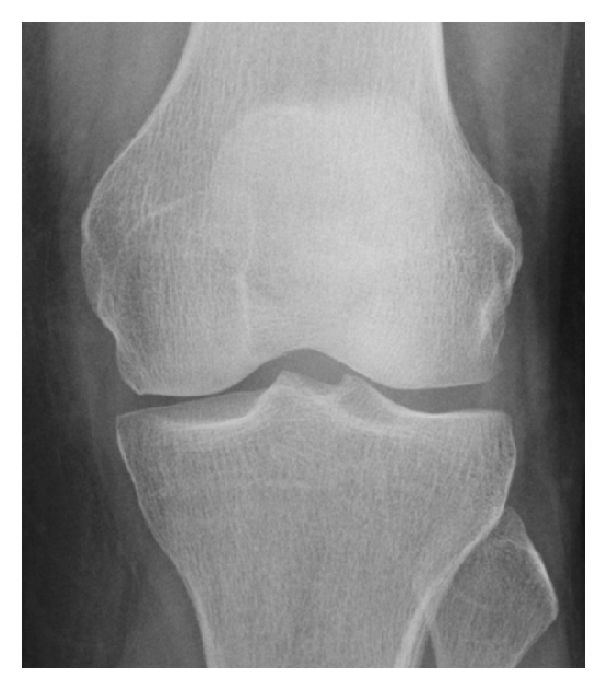 Tibial X-ray showing an occult metaphyseal stress fracture