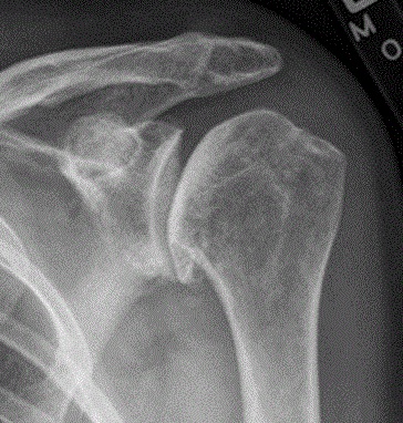 AP shoulder X-ray showing glenohumeral osteoarthritis with joint-space narrowing and osteophytes
