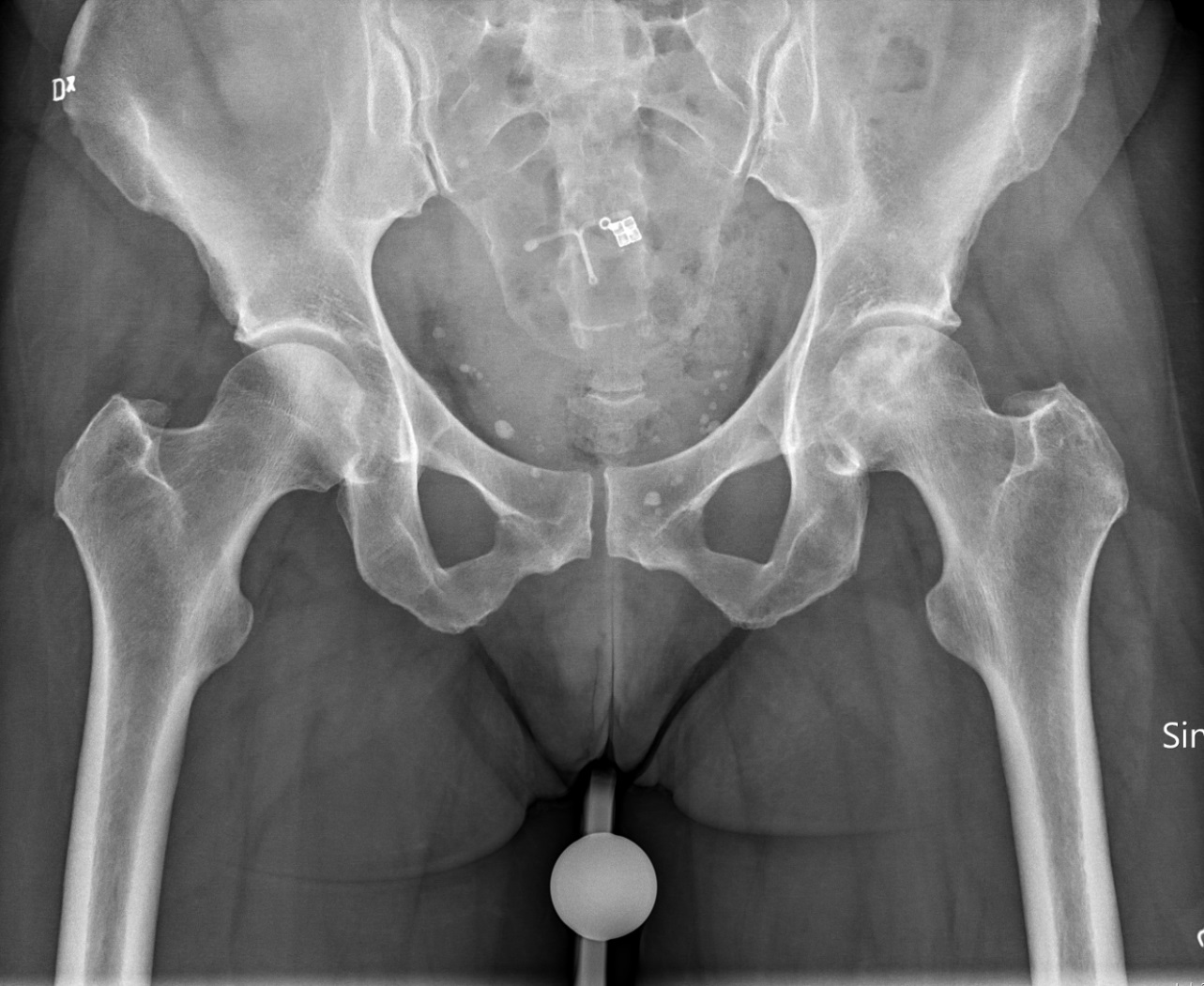 Pelvis X-ray showing avascular necrosis of the femoral head