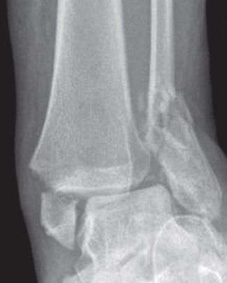 AP ankle X-ray showing a bimalleolar fracture with displaced medial and lateral malleolar fractures and widening of the ankle mortise.