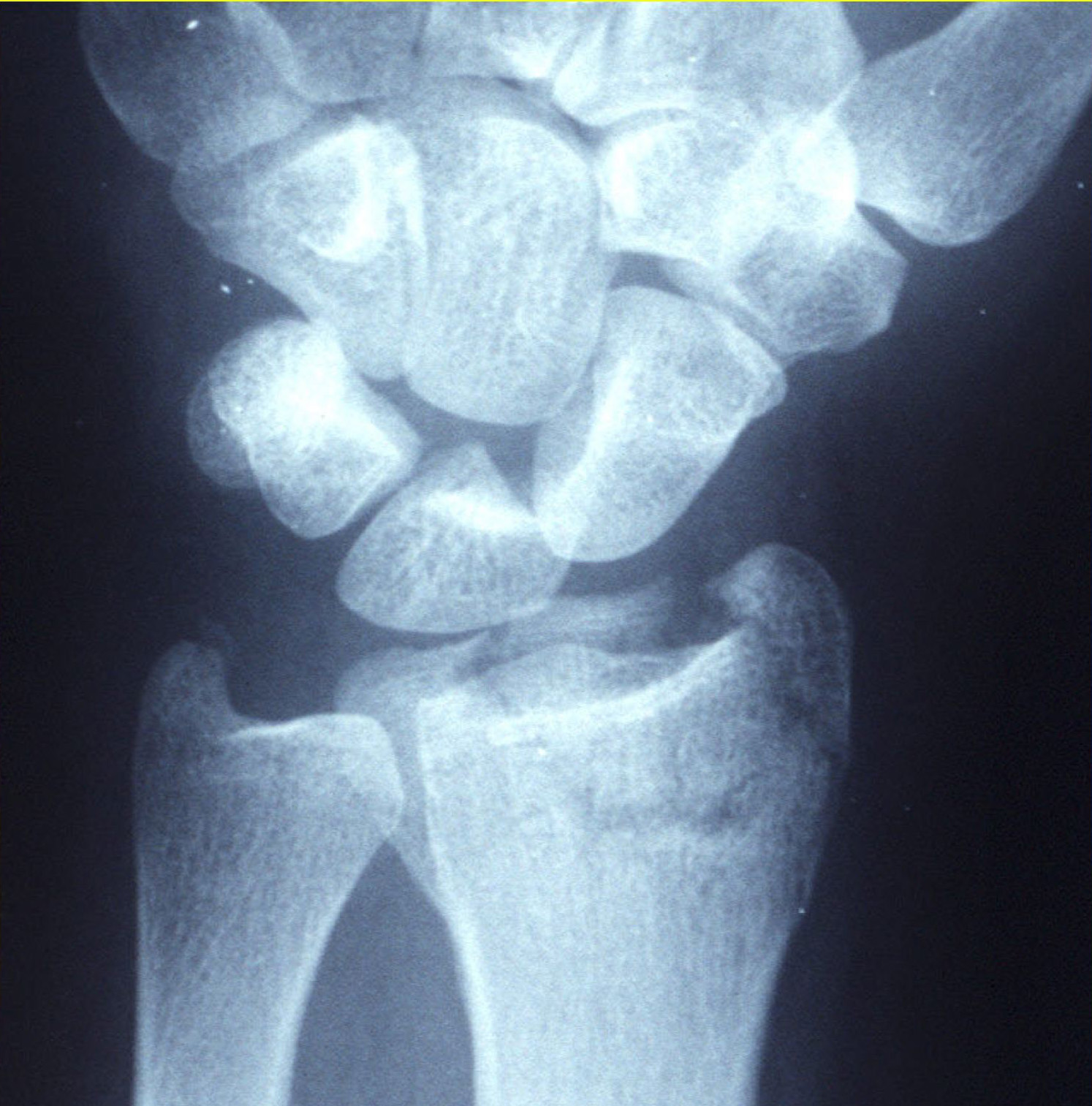 Lateral wrist X-ray showing a displaced distal radius fracture with dorsal angulation and shortening.