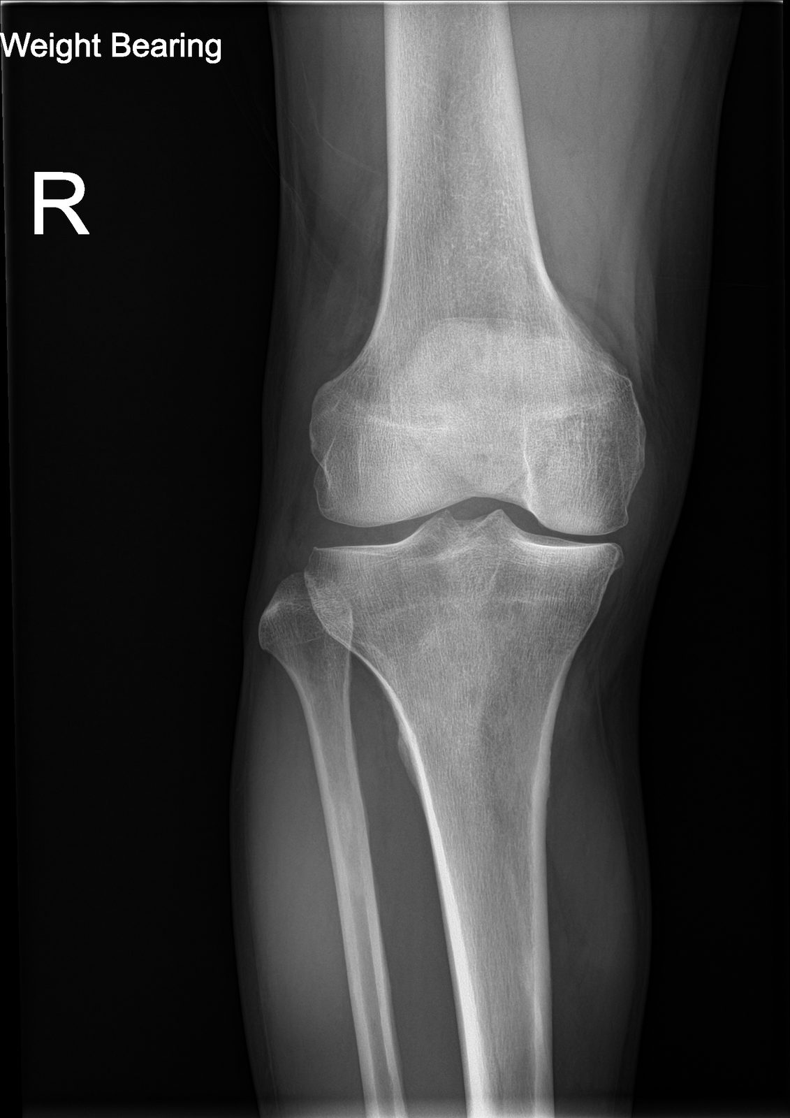Standing weight-bearing X-ray of a knee with medial joint-space narrowing from osteoarthritis