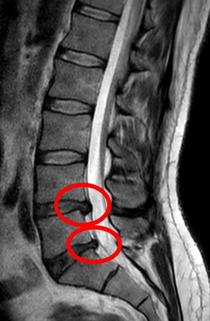Sagittal lumbar MRI showing a posterior disc herniation compressing the thecal sac at the L4-L5 level.