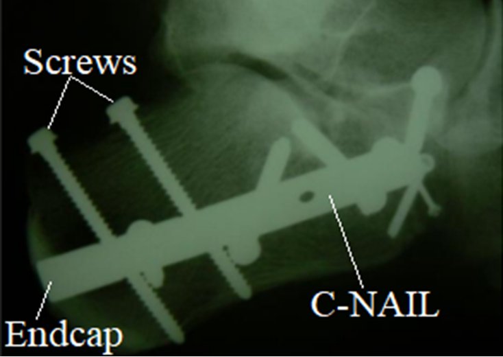 Lateral heel X-ray showing a calcaneus fracture fixed with an intraosseous C-nail and multiple transverse screws.