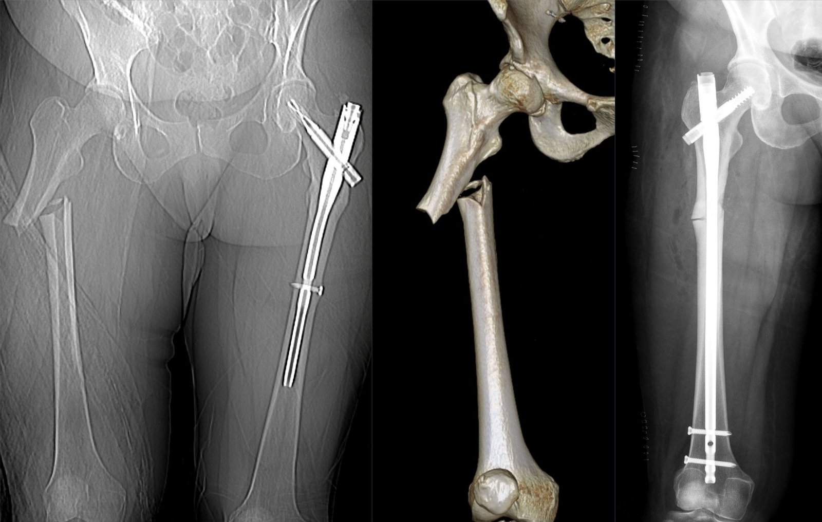 Three-panel imaging of a subtrochanteric femur fracture with a cephalomedullary nail construct in place.