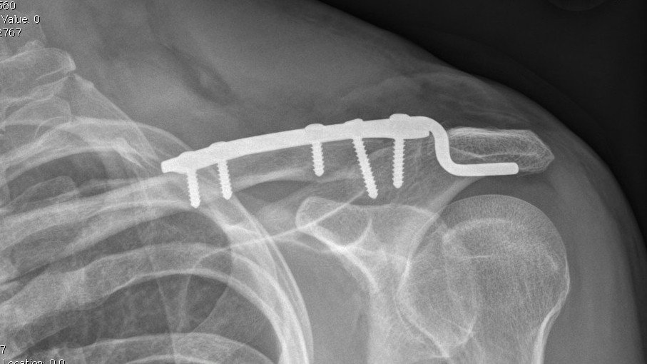 AP shoulder X-ray showing a displaced clavicle fracture fixed with a superior plate and six screws.