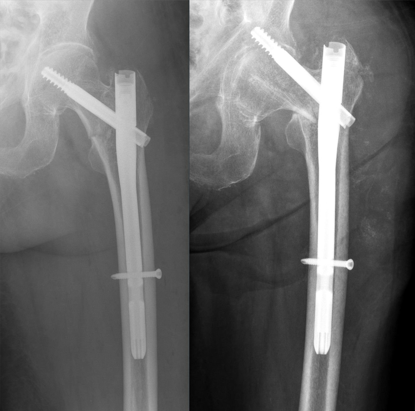 AP and lateral hip X-rays after cephalomedullary nail fixation of a proximal-femur fracture, showing a nail down the femur with a lag screw into the femoral head.