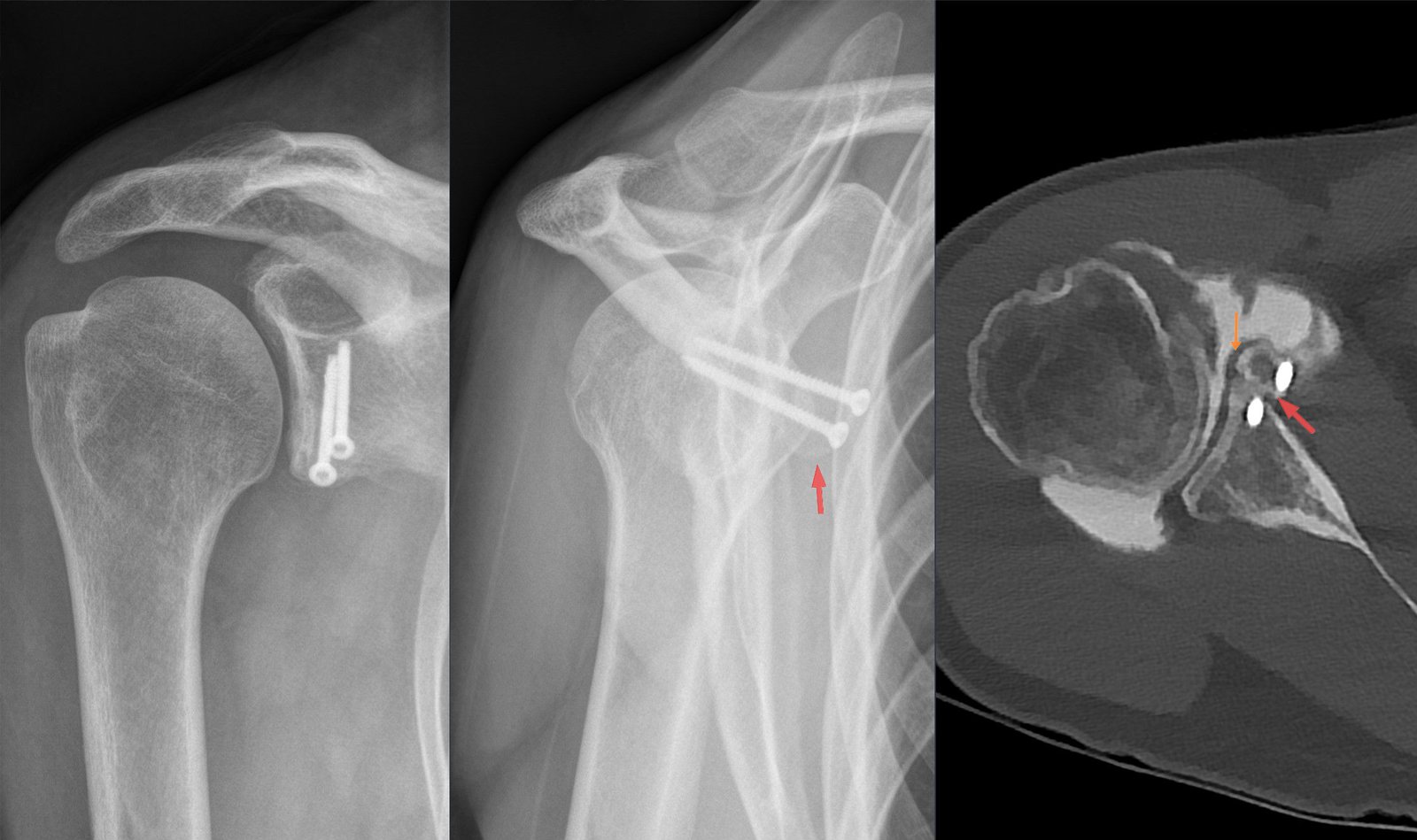 AP and axillary shoulder X-rays plus CT showing two cortical screws fixing a transferred coracoid bone block to the anteroinferior glenoid rim.