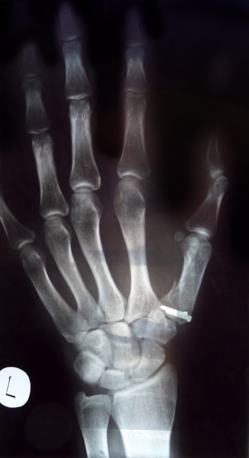 AP hand X-ray showing a Bennett fracture at the base of the thumb metacarpal fixed with a single screw.