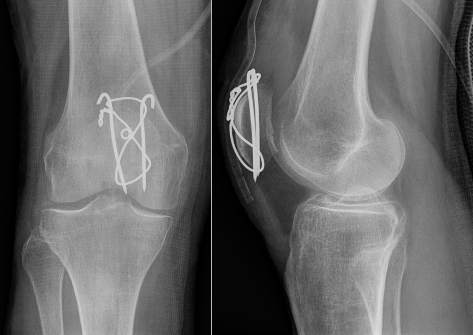 AP and lateral knee X-rays showing a transverse patella fracture fixed with a tension-band construct using K-wires and cerclage wire.
