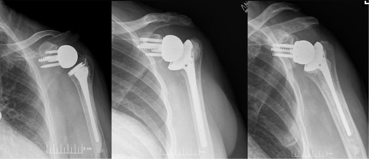 Three AP shoulder radiographs showing different designs of reverse total shoulder arthroplasty, each with a glenosphere bolted to the shoulder blade and a polyethylene cup seated on the humeral stem.