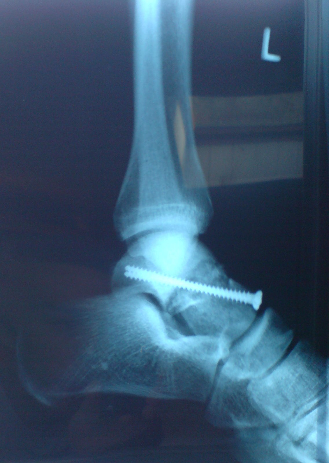 Lateral ankle X-ray showing a talar neck fracture fixed with a single large cortical lag screw across the fracture line.