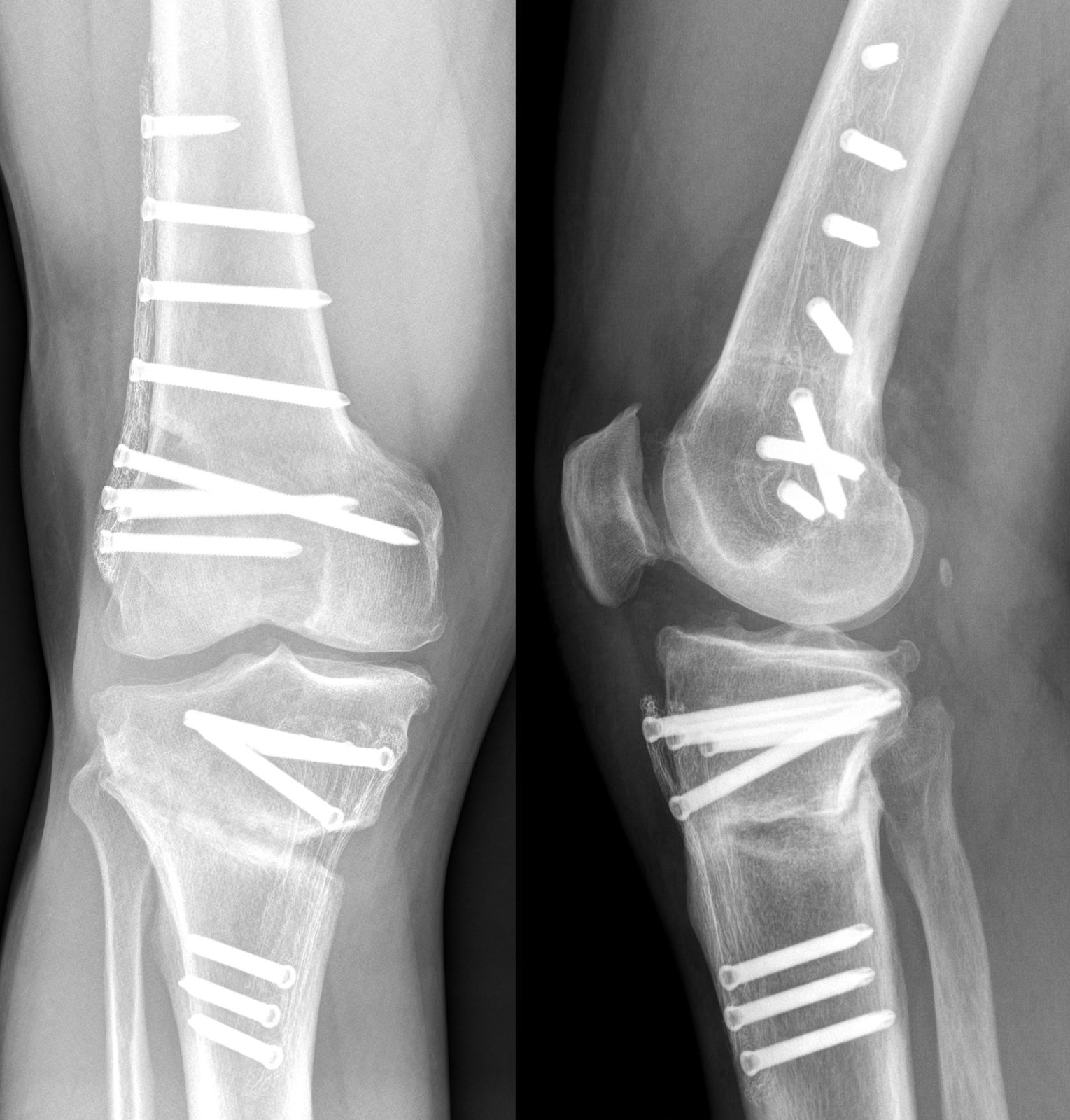 AP and lateral knee X-rays after complex tibial plateau and distal femur fracture fixation with multiple plates and screws.