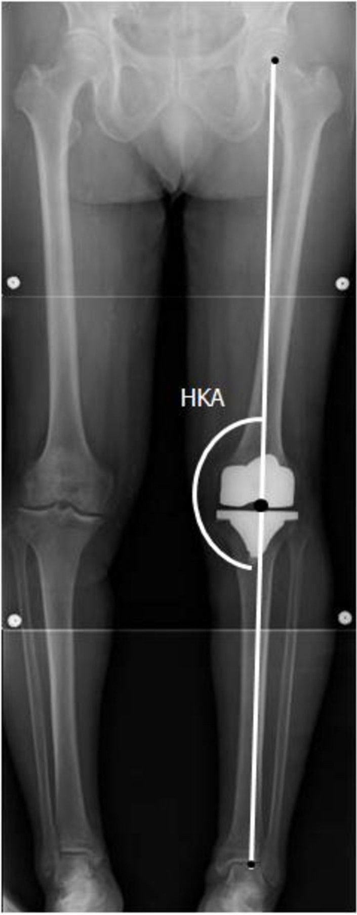 Standing long-leg X-ray showing a well-aligned total knee prosthesis with the hip-knee-ankle mechanical axis passing through the center of the knee replacement.