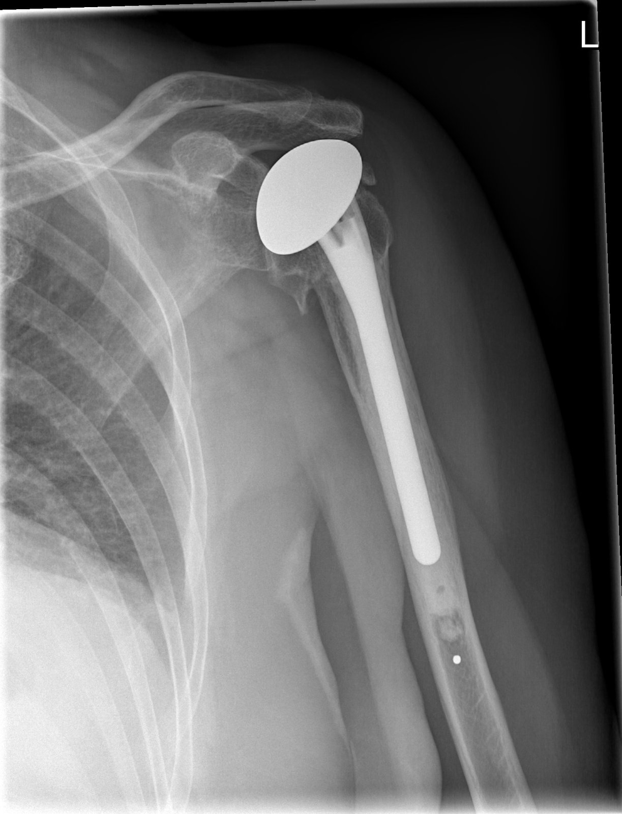 AP shoulder X-ray after anatomic total shoulder replacement showing a humeral stem down the arm bone and a new metal humeral head articulating with the glenoid of the shoulder blade.