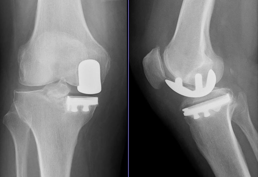 AP and lateral knee X-rays after unicompartmental (partial) knee replacement showing implants only on the medial (inner) side of the joint.